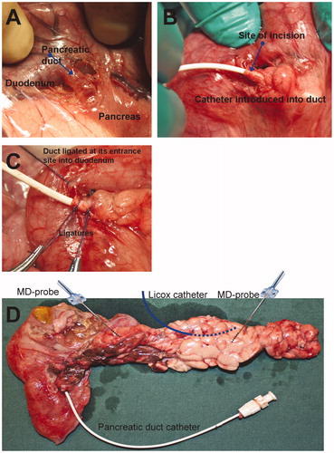 Figure 2. Panels A–C show the access, placement, and securing of a pancreatic duct catheter for taurocholate infusion. Panel D shows the placement of microdialysis probes, a Licox catheter, and a pancreatic duct catheter.