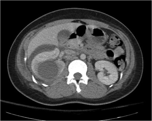 Figure 1. Renal cyst of 4.6 cm seen in right kidney (arrow), with perinephric fluid collection, also observed.