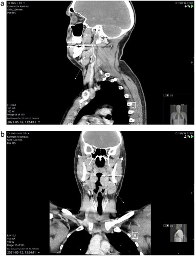 Figure 1. (a,b) Computer tomography showing metastasis of mucoepidermoid carcinoma in left neck level IIa.
