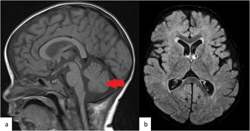 Figure 3. MRI brain Base line. Selected images from the MRI of the brain before the chemotherapy treatment. (a) Sagittal T1 weighted MR image at the midline demonstrate the mild cerebellar atrophy (arrow). (b, c) selected axial T2 weighted images of the supratentorial brain shows no evidence of white matter change.