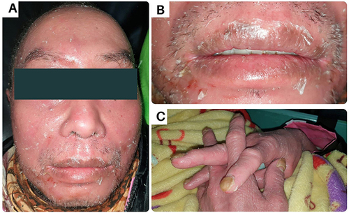 Figure 1 Extraoral condition on the first visit; (A) Reddish and peeling skin on the face; (B) Dry and exfoliative lips; (C) Nail thickening and joints appearing stiff.