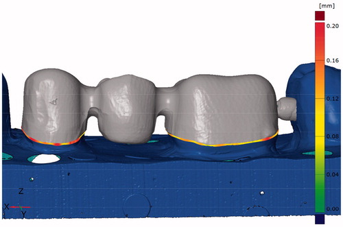 Figure 2. Image from the CAD software used for fit measurements with the triple-scan protocol. The measurements for the absolute marginal gap are indicated at the preparation margin.