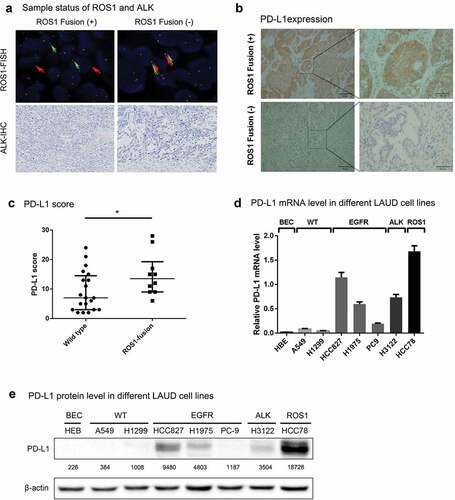 Figure 1. ROS1 fusion is associated with upregulated expression PD-L1 in NSCLC.