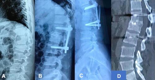 Figure 3 Good bone union in the patient with hardware failure: (A) preoperative X-ray; (B) postoperative X-ray; (C) final follow-up X-ray with hardware failure; (D) sagittal CT at last follow-up with good bone union.