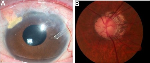 Figure 3 Four years following surgery, left eye anterior segment with gold shunt in good position (A), with stable glaucomatous optic neuropathy (B).