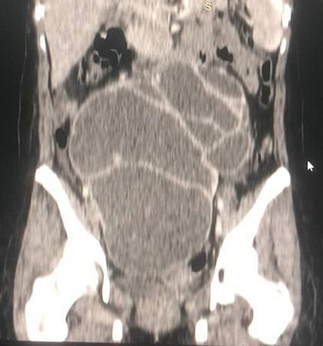 Figure 1 Coronal CT scan image of the giant ectopic hydronephrotic right kidney.