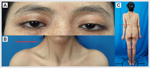 Figure 1 Clinical image of physical finding. (A) Ocular hypertelorism and left eye ptosis. (B) Webbed neck. (C) Scoliosis.