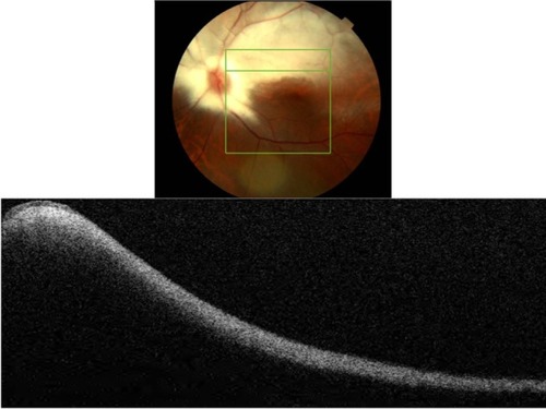Figure 2 Fundus photograph (top) showing MRNF; the B-scan line on the fundus photograph has the same width as the B-scan SD-OCT image (bottom); SD-OCT image demonstrates thickened RNFL due to MRNF, thickness of which increases closer to the optic nerve head.