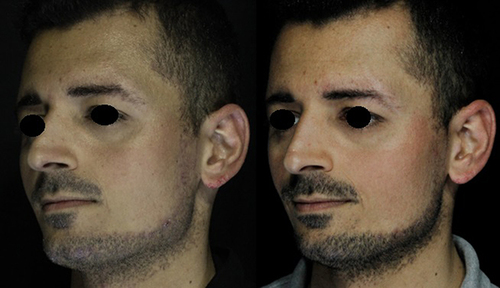 Figure 4 Left side of face crossed, front view.