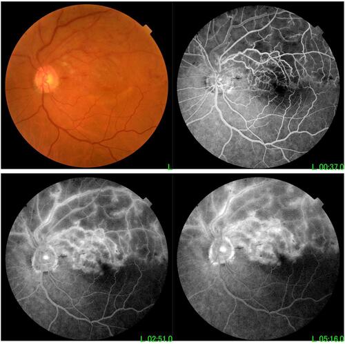 Figure 5 A case of BRVO (sectorial hemorrhages and exudates in superotemporal quadrant with dilated tortuous superotemporal retinal vein in colour photo with cystoid macular edema in early and late F/A photo).