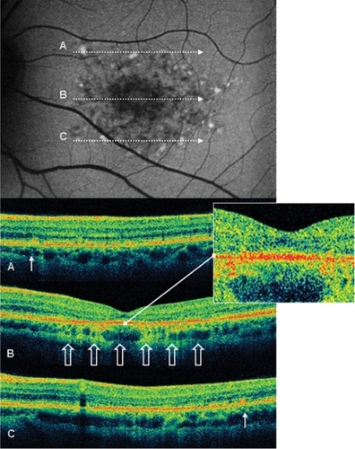 Figure 3 Case 8 fundus autofluorescence and high definition spectral domain optical coherence tomography (HD-OCT). Fundus autofluorescent frame of the left eye (20/125 best corrected visual acuity) shows mottled autofluorescence in the macular area and clearly delineates the retinal flecks. HD-OCT scans (A, B, and C) show a diffuse loss of the photoreceptor layer (enlarged view) in the foveal region (B, open arrows), and small hyperreflective lesions presented as dome-shaped deposits located within the retinal pigment epithelium (A and C, thin arrows).