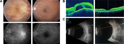 Figure 2 A 25-year-old female with unilateral VKH. (A) RE shows serous retinal detachment and optic nerve head hyperemia. LE fundus is normal. FFA shows RE late leakage and pooling of the dye. (B) RE OCT demonstrates the presence of subretinal fluid and septae, LE OCT is normal. (C) Ultrasonography reveals RE showing a diffuse choroidal thickening and LE showing a normal posterior segment.