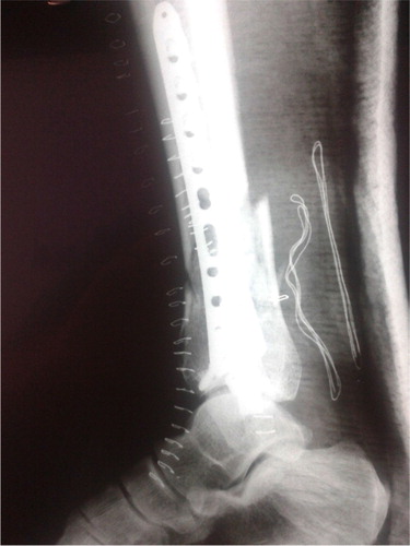 Fig. 3 Postoperative lateral lower extremity radiograph showing the internal fixation of the pilon fracture.