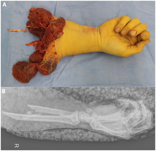 Figure 1. A shows the amputated right forearm of the 38-year-old patient from a palmar view in the operating theatre before replantation. B demonstrates the corresponding x-ray.