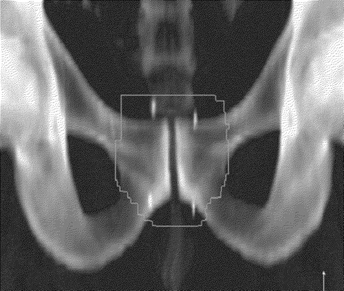 Figure 3.  Implanted gold markers, anterior-posterior film.