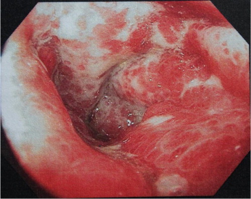 Fig. 2 Colonoscopic picture of splenic flexure showing edematous, erythematous, and friable mucosa.