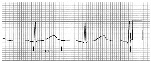 Figure 1 Schematic representation of the QT interval, which extends from the start of the QRS complex to the end of the T wave.