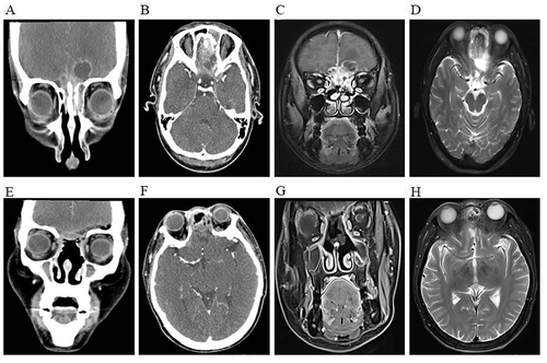 Figure 1 Preoperative and postoperative imaging results of malignant tumors of the anterior skull base. Coronal (A) and horizontal (B) enhanced computed tomography demonstrated a mass in the bilateral ethmoid sinus, olfactory sulcus, and anterior skull base involving the left frontal lobe with cerebral edema. Coronal T1 weighted (C) and horizontal T2 weighted (D) enhanced magnetic resonance imaging revealed a soft tissue mass in the bilateral ethmoid sinus floor, olfactory sulcus, and anterior skull base invading the base of bilateral frontal lobes, and was approximately 2.6cm*4.5cm*3.6cm. Three months after surgery, coronal (E) and horizontal (F) enhanced computed tomography showed that the bilateral nasal and anterior skull base mass had been removed with intracranial hemorrhage and gas largely absorbed. Coronal T1 weighted (G) and horizontal T2 weighted (H) enhanced magnetic resonance imaging did not reveal an abnormal strengthening mass in the bilateral nasal operative cavity.