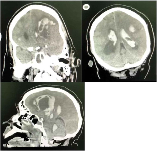 Figure 1. Shows a right hemispheric massive hemorrhagic infarct with ventricular extension in patient 1