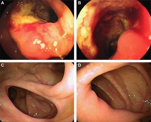 Figure 2 Colon under colonoscopy.
