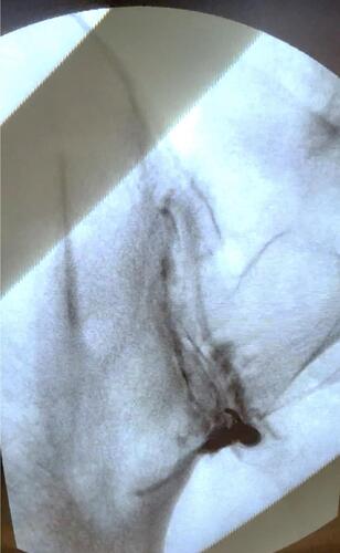 Figure 9 A fluoroscopic guided intra-articular SIJ injection utilizing the inferior joint approach. The fluoroscope is placed in contralateral oblique positioning. Typically oblique positioning is between 5 and 15 degrees, until the anterior and posterior sacroiliac joint lines intersect at the most inferior aspect of the joint.
