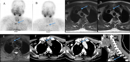Figure 1 Patient1: Dual-phase 99mTc-setaMIBI planar images at early 10 minutes and delayed 2 hours (A and B) reveal tracer high uptake. MRI images (C–E) and CT transaxial, and sagittal images (F–H) shows a lesion in the right side of superior mediastinum (arrow).