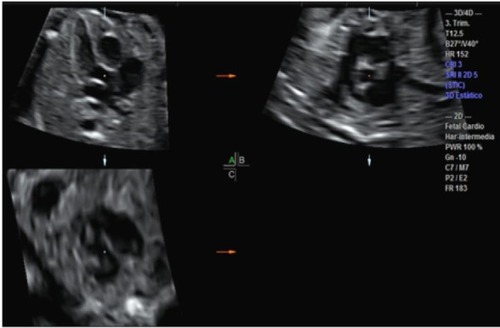 Figure 1 Technique of Gonçalves et alCitation14 for obtaining the outflow routes of the ventricles. Images in the three orthogonal planes of the fetal heart are obtained using the multiplanar mode of spatiotemporal image correlation, on the grey scale.