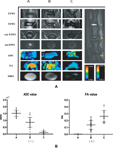 Figure 1 (A) The results of imaging gradient changes of the three groups of rat intervertebral discs (7.0T MRI) (B) Statistics of DTI measurement values of three groups of rat intervertebral discs, (A) ADC value statistics, (B) FA value statistics.