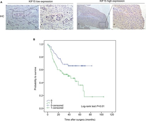 Figure 4 Correlation of KIF15 expression with clinicopathological characteristics and prognosis of bladder cancer patients.Notes: (A) IHC staining of KIF15 proteins in bladder cancer samples. (B) BC patients with high expression of KIF15 presented have worse overall survival, and low expression was opposite (P=0.01).Abbreviations: BC, bladder cancer; IHC, immunohistochemistry.