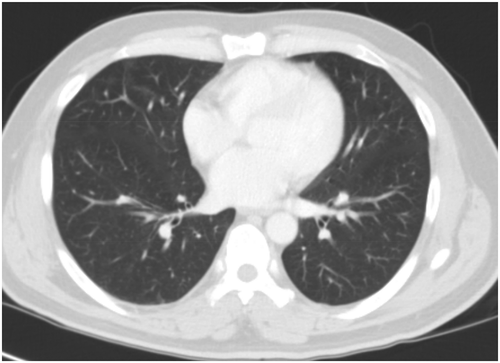 Figure 5. Follow-up CT chest 20-days post-discharge showing complete resolution of the multifocal opacities when compared to the patient’s hospitalization