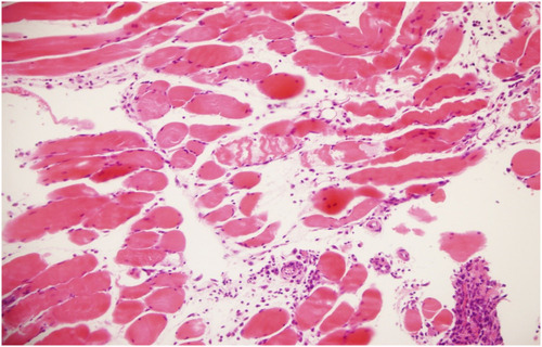 Figure 6 There are prominent focal acute necrotic change sites in muscular tissue sites and diffuse inflammatory cell infiltration (HE, 20x).