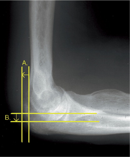 Figure 2. Preoperative measurements of the horizontal (A.) and vertical dislocation (B.) on lateral view. Horizontal dislocation is the distance between the posterior cortex of the humerus and the most proximal cortex of the olecranon when the elbow is flexed 90 degrees. Vertical dislocation is the distance between the humeroulnar joint surface and the lowest tip of the humeral medial condyle when the elbow is flexed 90 degrees. In elbows with severe destruction, the dislocation increased in both directions.