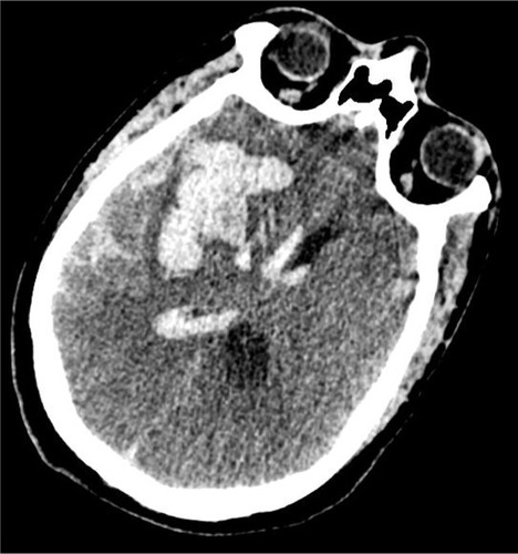 Figure 1 CT of head: Axial image showing large right intra-cerebral hemorrhage with extension into the ventricular system and subarachnoid space.