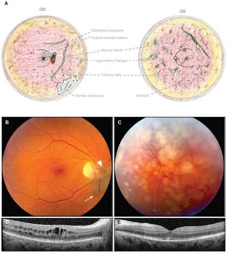 Figure 3 Twin B displays stage III ADNIV at the age of 49 years. (A) Fundus drawings record less severe epiretinal membrane and cystoid macular edema only OD. There was fibrotic vitreous traction at the disc and a fibrotic membrane over the pars plana OD. The peripheral retina showed pigmentary and atrophic changes. There were vitreous cells and vitreous bands OU. (B) Fundus photograph OD shows an epiretinal membrane and cystoid macular edema. At the optic disc there was fibrous traction (arrowhead) and pigmentary changes (arrow). (C) Fundus photograph OS shows asteroid in the vitreous. (D) Optical coherence tomography OD shows cystoid macular edema. (E) There was no cystoid macular edema OS.