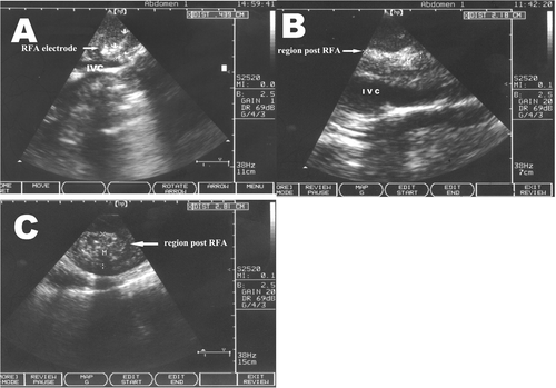 Figure 1. Sonography of the RFA region. (A) The tip of the RFA electrode is close to the IVC; (B) Near the IVC, one can see a long fusiform shape post RFA; (C) At a distance from the IVC, the shape post RFA is circular.