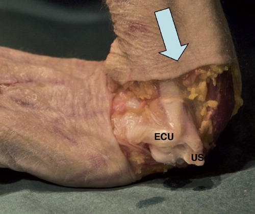 Figure 1. The TFCC is forced into rupture (specimen 4). The ulnar head is bald. Note the ECU tendon sheath torn out of its groove in the distal ulna. US: ulnar styloid with a type-1 fracture; bold arrow: longitudinal force applied to the forearm.