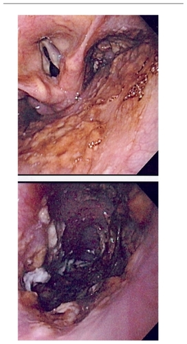 Figure 2 Esophageal candidiasis.