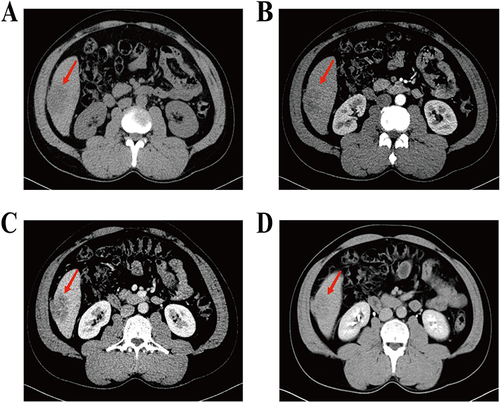 Figure 1 Computed tomography (CT) scans before the first operation. A mass (red arrow) measuring 4.6×4.3×5.3 cm in S5/6 junction of right lobe of liver was showed on CT scans. (A) plain scan; (B) arterial phase; (C) portal venous phase; (D) venous phase.