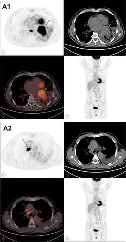 Figure 4 (A1 and A2) PETCT on August 27, 2020; The increased mass of FDG metabolism in the hyperplastic block indicated by the arrow.