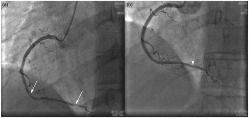 Figure 2. Coronary angiography showing (a) middle and distal dissection of the right coronary artery and (b) reperfusion after placement of two drug-eluting stents after the previously placed proximal stent.