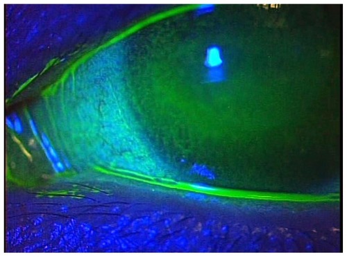 Figure 1 Slit lamp with fluorescence at the patient’s first visit.