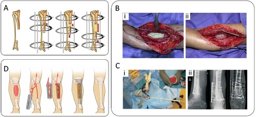 Figure 1. Current gold standard techniques for the treatment of non-unions. (A) Schematic representation of the distraction osteogenesis technique. After the formation of a critical size defect, the two bone ends are brought into contact. The Ilizarov apparatus (external fixation) is used to gradually separate the two bone segments, allowing new bone to form in the gap via conventional endochondral ossification during fracture healing. Adapted with permission from Ref. [Citation22]. (B) Clinical case in which the Masquelet technique was applied to treat a humeral non-union. (i) After debridement of the bone ends, a cement spacer was inserted for 2 months. (ii) After this period, a pearly membrane was induced around the cement, which was filled with a bone graft after spacer removal. Adapted with permission from Ref. [Citation18]. (C) Clinical case combining the Masquelet technique with an intramedullary bone graft to treat a tibial non-union. (i) After PMMA spacer removal and the induced membrane formation, the defect site was packed with autologous cancellous bone graft collected from the femur with the reamer-irrigator aspirator (RIA) technique. (ii) 7 months post-surgery X-rays. (D) Schematic representation of the vascularized fibula approach combined with a supporting construct comprising the following steps: resection of malignant tumour, construct placed around the vascularized fibular graft, insertion in the critical size defect and use of internal fixation. Adapted with permission from Ref. [Citation23].