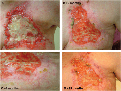 Figure 3. Clinical example of ECT effectiveness for palliative patients. (A) Chest wall recurrence of an inflammatory breast cancer prior to ECT treatment and unresponsive to systemic chemotherapy. ECT was applied to the whole chest wall once at every 3 months follow up (B, C and D). The ulcerated tissue shows a dramatic decrease in size and as a result large areas of re-epithelialisation are evident.
