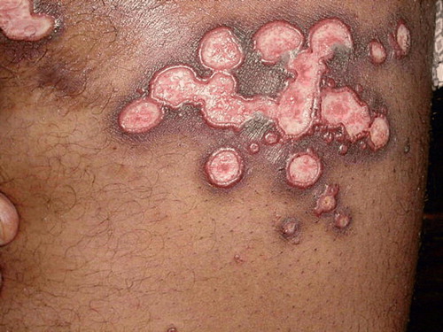 Figure 1.  Shallow ulcerations with infiltrated borders that appeared after the evolution to the chronic form of the disease.