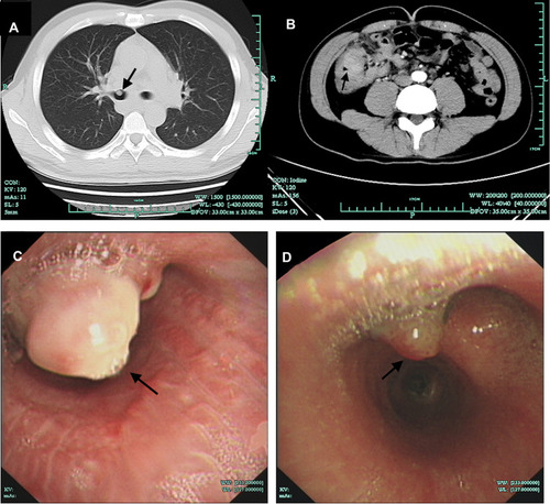 Figure 2 Computed tomography and Bronchoscopy findings. (A) Chest CT showed a nodular lesion in the right main bronchus (arrow). (B) Abdominal CT showed a mass in the right lower abdomen (arrow). (C) Bronchoscopy showed nodules in the right bronchus (arrow). (D) The nodule in the right bronchus was smaller after five months of treatment (arrow).