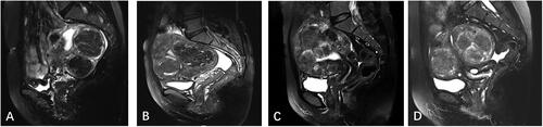 Figure 2. Signal intensity of uterine fibroids on T2WI of MRI. A: multiple uterine fibroids with hypointensity signal; B: multiple uterine fibroids with isointensity signal; C: multiple uterine fibroids with hyperintensity signal; D: multiple uterine fibroids with mixed hyperintensity signal.