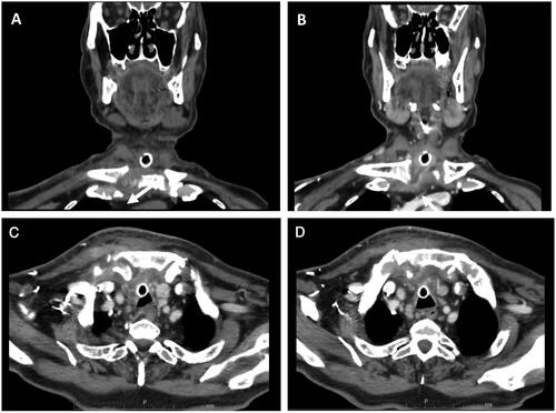Figure 1. (A) Coronal and (C) Axial contrast-enhanced CT of the head, neck and chest shows irregularity of the right clavicular and sternal cortical bone (arrows). (B) Coronal and (D) Axial contrast-enhanced CT of the head, neck and chest shows effusion in the right sternoclavicular joint, with thickening and increased synovial uptake.
