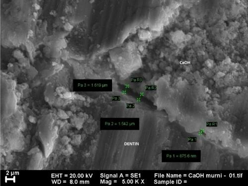 Figure 1 SEM image of group treated with CaOH2 at 5000x magnification.