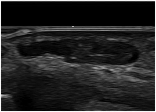 Figure 1. Preoperative ultrasonography reveals about 0.7 × 0.3 × 1.2 cm sized cystic lesion with no remarkable increased vascularity.