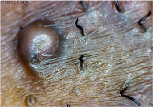 Figure 7 Use of depilatories produced two crooked blunt tips unlikely to cause penetration in a patient with existing papules.